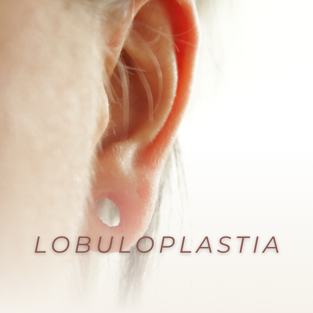 lobuloplastia
